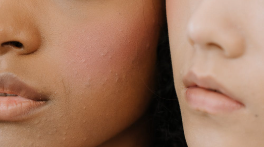 Why Am I Breaking Out? Is it Skin Purging or Is it Acne?