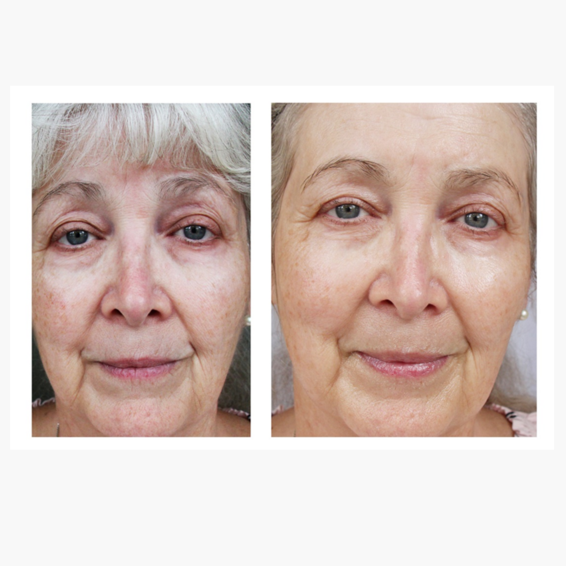 Before & After of woman with brightened complexion and reduced redness