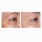Before & After picture of a woman's eyes with improved fine lines, wrinkles and dark spots