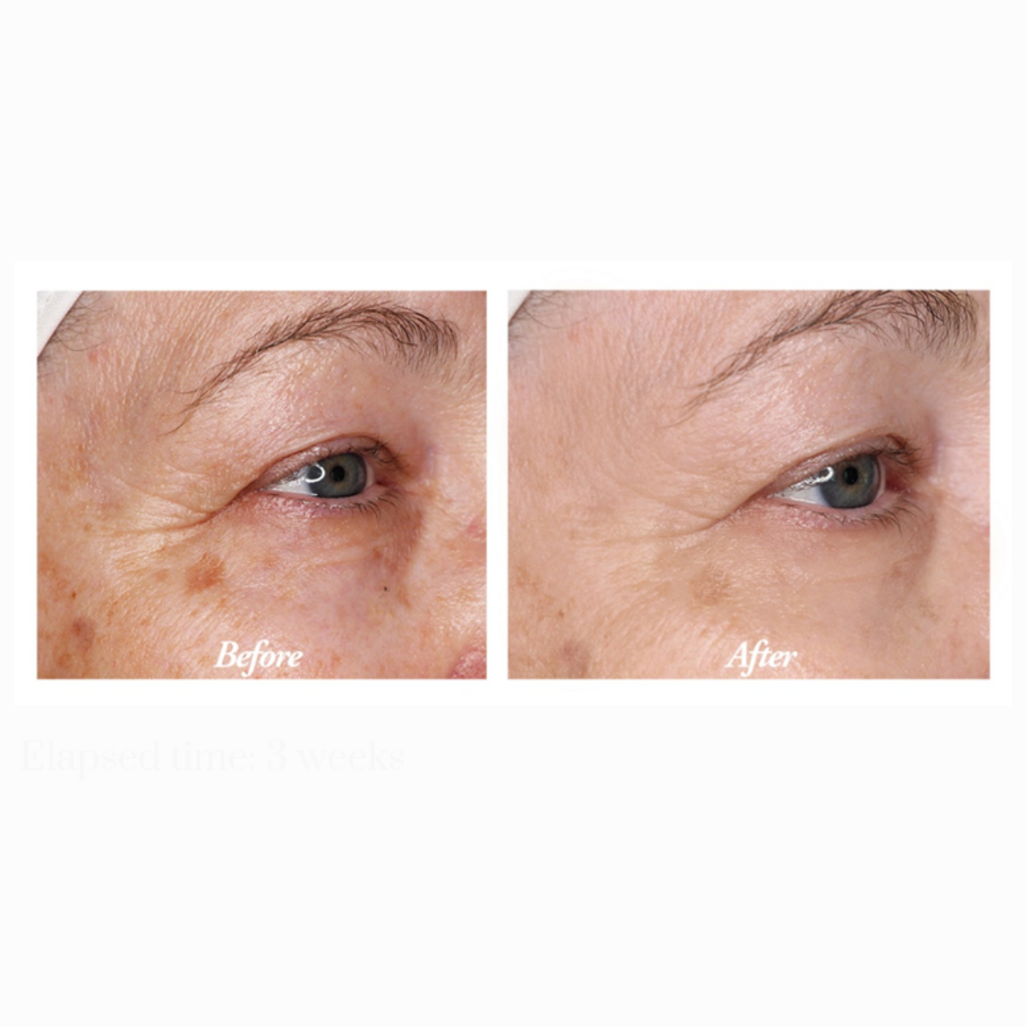 Before & After picture of a woman's eyes with improved fine lines, wrinkles and dark spots